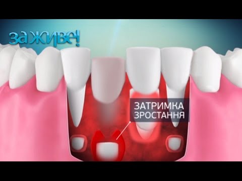Видео: 5 методов, которые помогут вырвать молочный зуб ребенку – За живе! Сезон 3. Выпуск 72 от 29.12.16