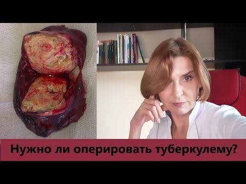 Видео: Нужно ли оперировать туберкулему