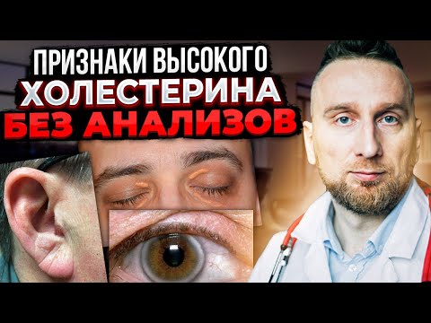 Видео: Как определить повышенный холестерин по глазам и ... Кардиолог @Доктор Утин
