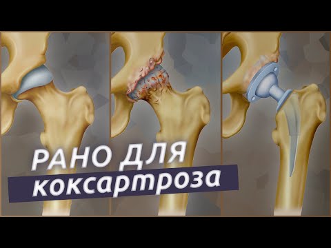 Видео: Боль в бедре это коксартроз? Как не допустить замену сустава?