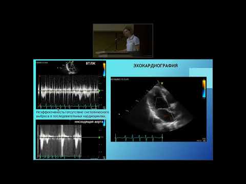 Видео: Клинический случай фокусной предсердной тахикардии у подростка