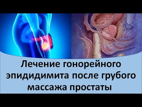 Видео: Лечение гонорейного эпидидимита после грубого массажа простаты