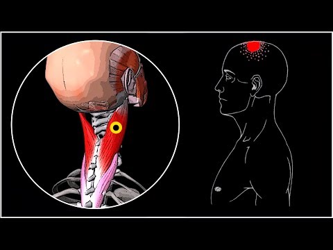 Видео: БОЛИТ ГОЛОВА И ШЕЯ 🔴 Ременная мышца головы и шеи