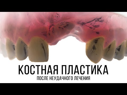 Видео: Костная пластика ламинатами после неудачной имплантации. Autogenous lamina GBR after implant failure