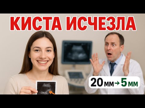 Видео: Врачи в ШОКЕ: эндометриоидная киста растворилась без единой таблетки