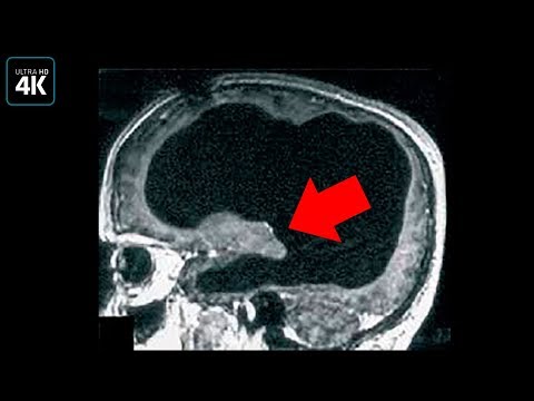 Видео: Жил 40 лет БЕЗ мозга, и вот почему это возможно!