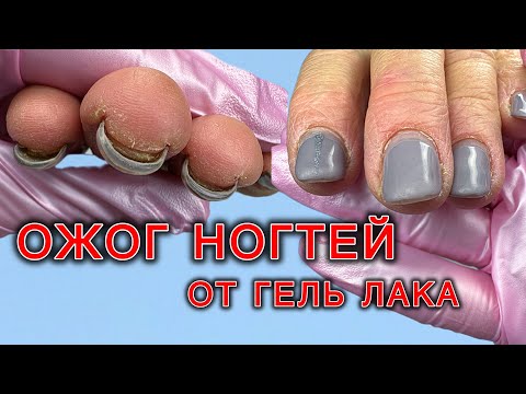 Видео: ИСПОРТИЛИ НОГТИ. Больше нельзя покрывать гель лаком ⛔️ КТО В ЭТОМ ВИНОВАТ? #подология #ожогногтей