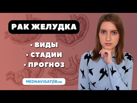 Видео: РАК ЖЕЛУДКА - виды, стадии, прогноз | Сколько живут с ОПУХОЛЬЮ ЖЕЛУДКА? #меднавигатор