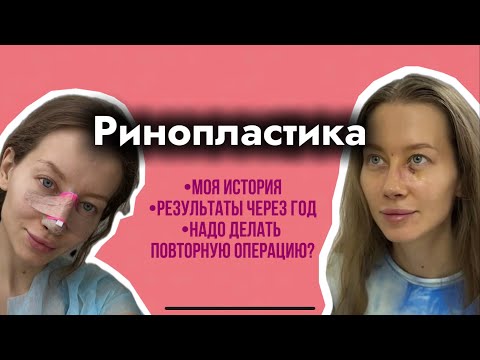 Видео: История моей ринопластики. Результаты ринопластики через год. Довольна ли я результатом?