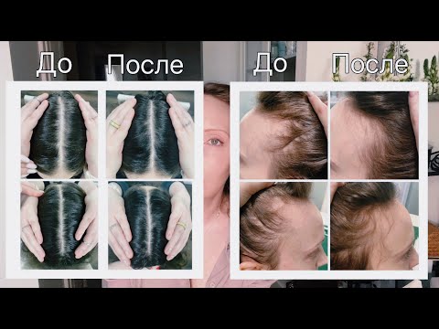 Видео: Волосы выпадают. А я их лечу. Визит к трихологу. Трихоскопия. Терапия