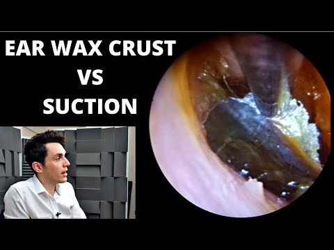 Видео: Засохшая ушная сера против аспирации