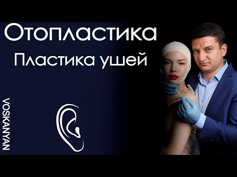 Видео: Отопластика ушей,  пластика ушных раковин . Коррекция ушей