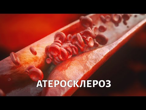 Видео: Доктор БОКЕРИЯ. Кому грозит атеросклероз?