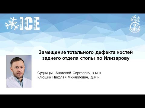 Видео: Замещение тотального дефекта костей заднего отдела стопы по Илизарову