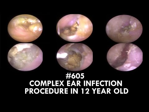 Видео: 605 - Сложная процедура лечения ушной инфекции у 12-летнего ребенка