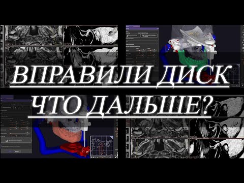 Видео: Рот открывается криво. Щелчки в челюсти. Вывих диска.