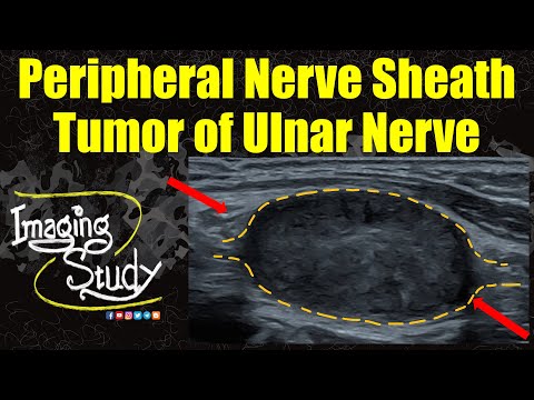 Видео: Опухоль оболочки периферического нерва локтевого нерва || Ультразвуковое исследование || Случай 361
