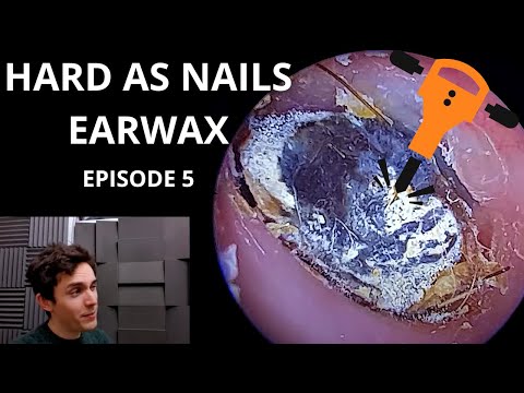 Видео: Твёрдая как гвозди ушная сера ЭПИЗОД 5