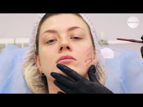 Видео: Процедура Neauvia Stimulate