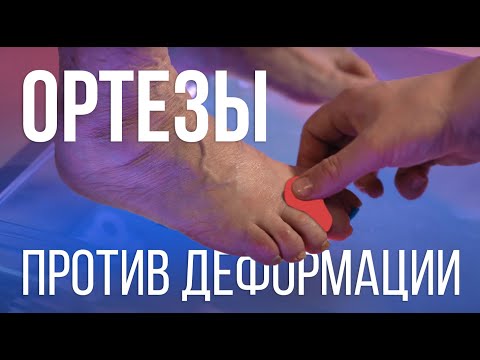 Видео: Ортезы – ЧТО ЛЕЧАТ?