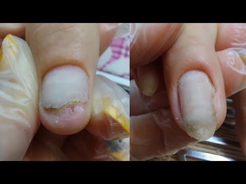 Видео: ПРОТЕЗИРОВАНИЕ ногтевой пластины / динамика роста