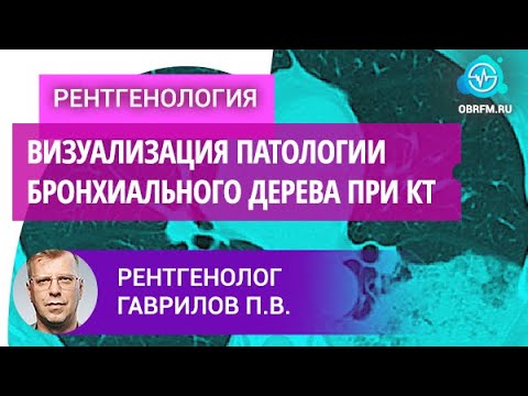 Видео: Рентгенолог Гаврилов П.В.: Визуализация патологии бронхиального дерева при компьютерной томографии