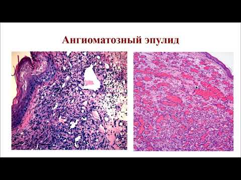 Видео: Электив. Опухоли слюнных желез