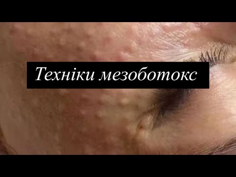 Видео: Мезоботокс та коктейль Монако 🇲🇨 Протоколы введения и безопасные зоны