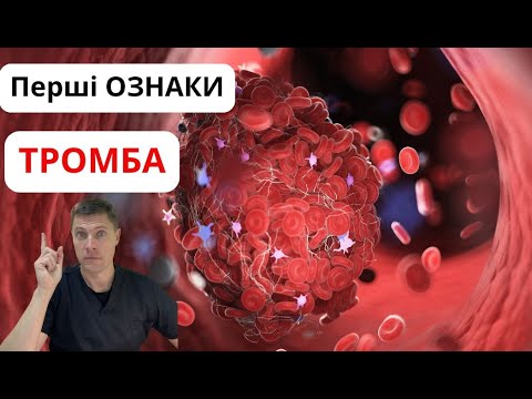Видео: Тромб, Перші ознаки! Як виявити тромб вчасно? Що не можна Ігнорувати