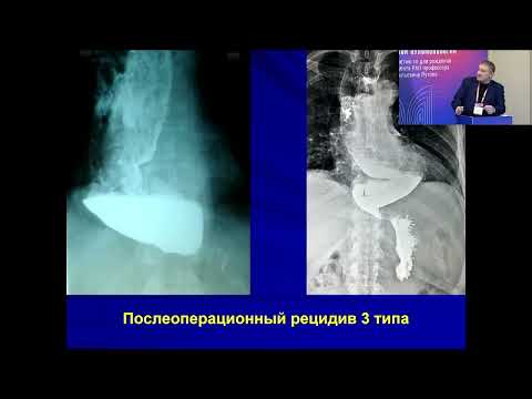 Видео: Малоинвазивное лечение ахалазии кардии: лапароскопия или пероральная эзофагомиотомия