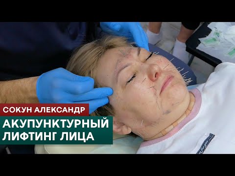 Видео: Акупунктурный лифтинг лица. Техники иглоукалывания для омоложения. Сокун Александр