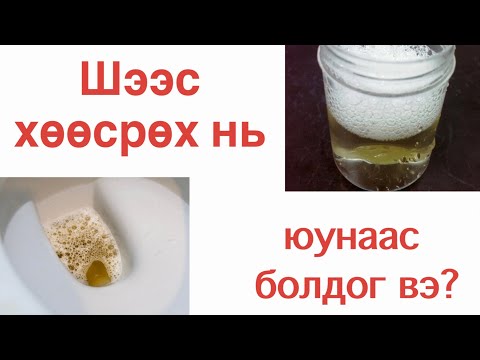 Видео: шээсээр уураг алдах хэр аюултай вэ?