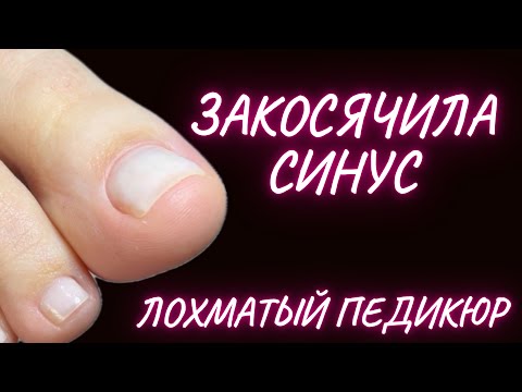 Видео: ПЕДИКЮР | ОБРАБОТКА ПАЛЬЦЕВ | лохматый синус