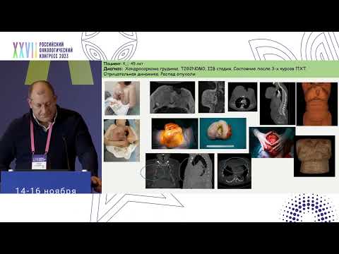 Видео: Нерезектабельные саркомы: есть ли выход?