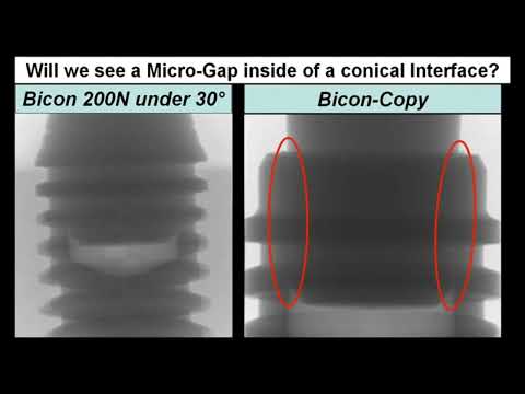 Видео: Микроподвижность в системе абатмент-имплантат. Причины и последствия