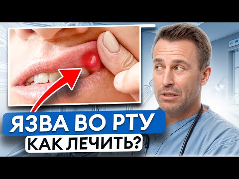 Видео: Как избавиться от СТОМАТИТА? / Причины и эффективное лечение язвы во рту