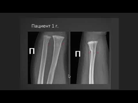 Видео: Лучевая диагностика переломов на примере клинических случаев