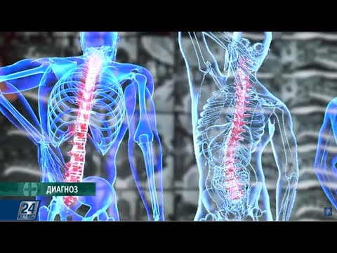 Видео: Сколиоз ауруы | Диагноз