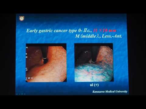 Видео: 02 Tohru Itoh   Диагностика и лечение раннего рака желудка