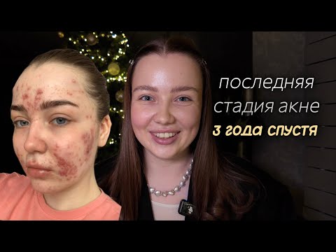 Видео: последняя стадия акне | как выглядит кожа спустя 3 года | побочки ретиноидов | случился ли рецидив?