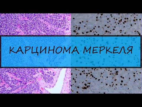 Видео: Карцинома из клеток Меркеля