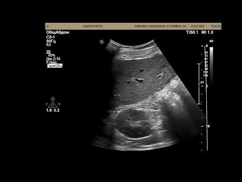 Видео: Нефролитиаз , кисты почек