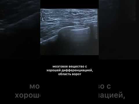 Видео: #узи #лимфоузел