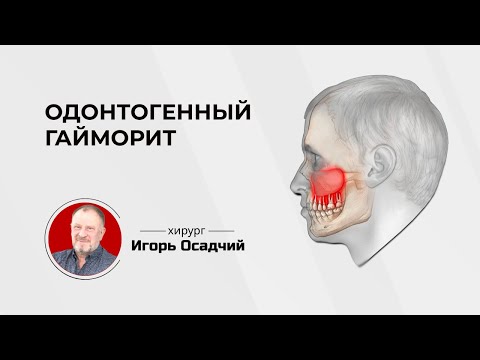 Видео: Одонтогенный или стоматологический гайморит