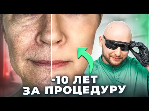 Видео: Омоложение за одну процедуру | Игольчатый RF: результаты до и после | Косметология в Москве