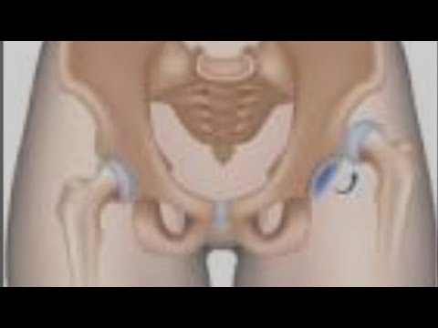 Видео: Реабилитация при артрозе тазобедренного сустава