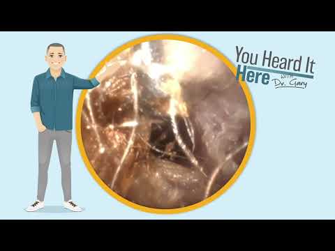 Видео: Запутавшаяся ушная сера и волосы в ушах — удаление «птичьего гнезда» | Видеообзор удаления ушной ...