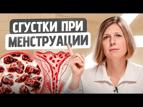 Видео: Чем опасны сгустки во время месячных? 4 признака нормальных месячных