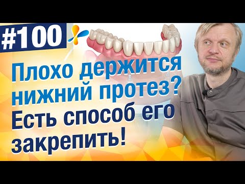 Видео: Закрепить нижний зубной протез на имплантах. Цена? Почему это самый удобный способ крепления?