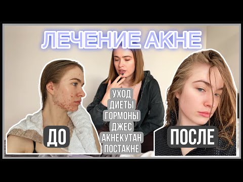 Видео: ЛЕЧЕНИЕ АКНЕ: 11 лет экспериментов. АКНЕКУТАН, ДЖЕС, ДИЕТЫ.